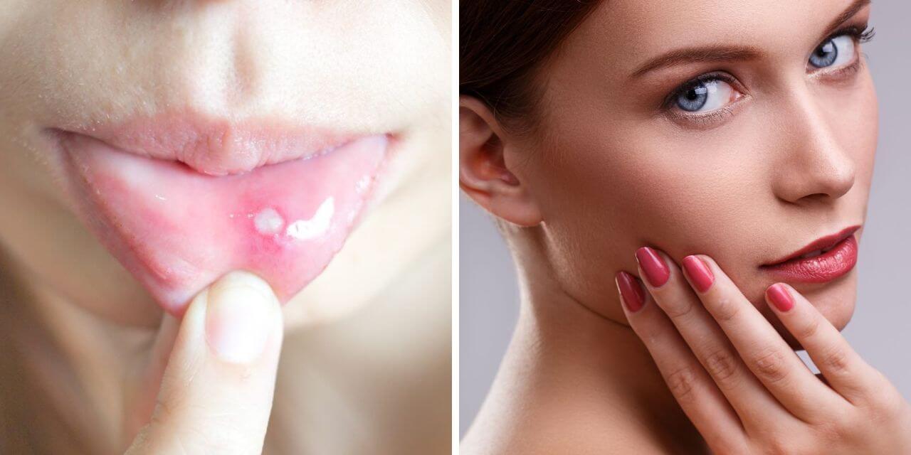 Lysine for Canker Sores and Cold Sores